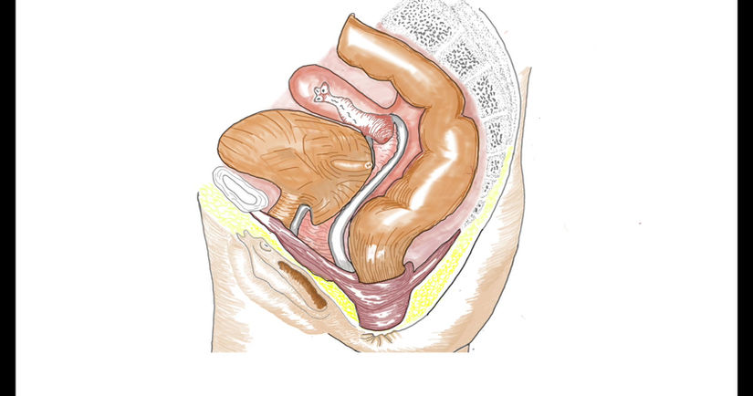 Pelvic Support Problems